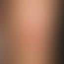 Rhomboid-to-W transposition flap plasty. irregularly limited, centrally erosive psoriasiform plaq...