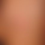 T-plasty, curved to reduce the defect. reddish tumor surrounded by a scaly crest, slightly raised...