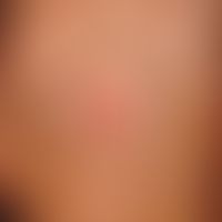 T-plasty, curved to reduce the defect. reddish tumor surrounded by a scaly crest, slightly raised...