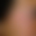 Verschiebelappenplastik, T-Verschiebelappenplastik, kombiniert. Abb. 1 c: Verlaufsdokumentation: ...