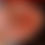 Verschiebelappenplastik, T-Verschiebelappenplastik, kombiniert. Abb. 2 b: Keilförmige Exzision de...
