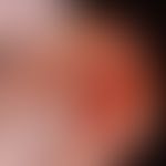 Verschiebelappenplastik, T-Verschiebelappenplastik, kombiniert. Abb. 2 c: Nach erfolgter Dehnungs...
