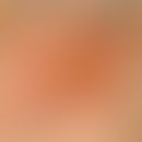 Rotational flap plasty, double. 3 x 4 cm large map-like bordered reddish-brownish plaque with pea...