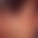 Trapezoidal flap plasty. map-shaped limited plaque in the region zygomatica in a 58-year-old woma...