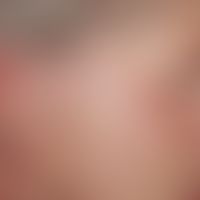 Trapezoidal flap plasty: Postoperative suture after defect coverage by displacement of a trapezoi...