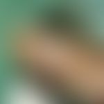 Vollhauttransplantat, präaurikuläres. Abb. 2 c: Einpassen des Vollhauttransplantates in das Empfä...
