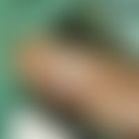 Vollhauttransplantat, präaurikuläres. Abb. 2 c: Einpassen des Vollhauttransplantates in das Empfä...
