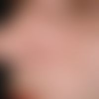 Vollhauttransplantat, präaurikuläres. Abb. 2 d: Verlaufsdokumentation: 11 Jahre post operationem.
