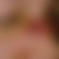 Vollhauttransplantat, präaurikuläres. Abb. 3 b: Verlaufsdokumentation: 5 Tage nach der Transplant...