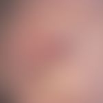 Doppeltranspositionslappenplastik. Postoperative Nahtverhältnisse nach Doppeltranspositionslappen...