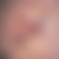 Doppeltranspositionslappenplastik. Postoperative Nahtverhältnisse nach Doppeltranspositionslappen...