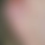 auricular reduction surgery. fig. 2 a: in the region of the lateral anthelix limb sharply defined...