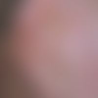 Ohrmuschelverkleinerungsplastik. Abb. 2 b: Verlaufsdokumentation: 4 Jahre post operationem nach v...