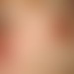 Simultaneous excision. Fig. 1 a: Infraorbital round keratotic tumor with central, slightly sunken...