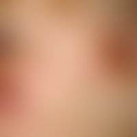 Simultaneous excision. Fig. 1 a: Infraorbital round keratotic tumor with central, slightly sunken...