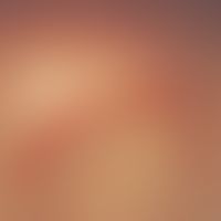 Simultaneous excision. Fig. 2 a: Protrusion of the skin by a fist-sized subcutaneous tumor in the...