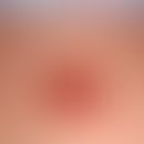 Displacement flap, subcutaneously stalked. sharply defined reddish-brown, partially bordering, 3....