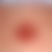 Verschiebelappen, subkutan gestielter. Scharf  begrenzte rötlichbraune, teilweise randbetonte, 3,...