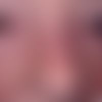 Verschiebeplastik, U-Verschiebelappenplastik. Verlaufsdokumentation: 5 Jahre post operationem.