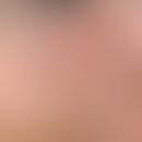 Verschiebelappenplastik, konkave. Präaurikuläre, mit hämorrhagischen Krusten belegte, leicht eing...