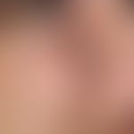 Verschiebelappenplastik, konkave. Postoperative Nahtverhältnisse nach Deckung des keilförmigen De...