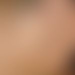 Verschiebelappenplastik, konkave. Verlaufsdokumentation: Hautzustand 2 Jahre post operationem.