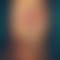 V-Y-plasty. on the forearm extension side irregularly sharply limited, scaly, partly erosive-crus...