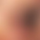 Blepharoplastik. Ausgeprägte Blepharochalasis des Ober- und Unterlides mit multiplen Fettgewebshe...
