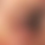 Blepharoplasty: Pronounced blepharochalasis of the upper and lower eyelid with multiple fatty tis...