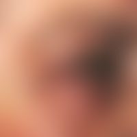 Blepharoplastik. Ausgeprägte Blepharochalasis des Ober- und Unterlides mit multiplen Fettgewebshe...