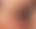 Blepharoplastik. Ausgeprägte Blepharochalasis des Ober- und Unterlides mit multiplen Fettgewebshe...