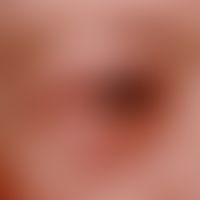 Blepharoplastik. Verlaufsdokumentation: 6 Monate nach einer Blepharoplastik an Ober- und Unterlid.