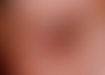Blepharoplastik. Verlaufsdokumentation: 6 Monate nach einer Blepharoplastik an Ober- und Unterlid.