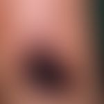 Skin transplantation, defective. fig. 1: Condition after excision of a burn scar with chronic ulc...