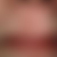 Skin graft, faulty. Fig. 2 a: Basal cell carcinoma above the upper lip.