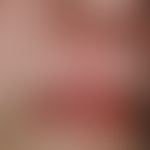 Skin graft, faulty. Fig. 2 b: Condition after basalioma excision and covering of the defect with ...