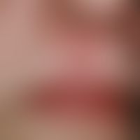 Skin graft, faulty. Fig. 2 b: Condition after basalioma excision and covering of the defect with ...
