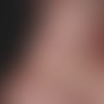 Skin graft, faulty. Fig. 3: Full-thickness skin graft at the bridge of the nose above the skin le...