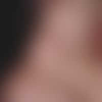 Skin graft, faulty. Fig. 3: Full-thickness skin graft at the bridge of the nose above the skin le...