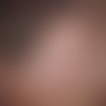 Skin transplantation, faulty. Fig. 4: Defect coverage of the forehead-hairline by means of full s...