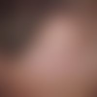 Skin transplantation, faulty. Fig. 4: Defect coverage of the forehead-hairline by means of full s...