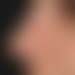 Skin graft, defective. Fig. 5: Defect coverage above the nostril by means of retroauricular full ...