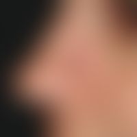Skin graft, defective. Fig. 5: Defect coverage above the nostril by means of retroauricular full ...