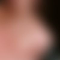 Skin graft, defective. Fig. 6: Graft shrinkage after excision of a basal cell carcinoma at the ti...
