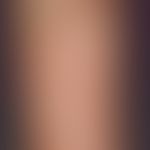 Skin transplantation, faulty. fig. 7: Shrinking of split skin flaps. defect coverage by animal fl...