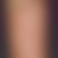 Skin transplantation, faulty. fig. 7: Shrinking of split skin flaps. defect coverage by animal fl...