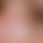 Skin transplantation, faulty. Fig. 8: Defect coverage of the nose side by full skin from the uppe...