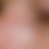Skin transplantation, faulty. Fig. 8: Defect coverage of the nose side by full skin from the uppe...