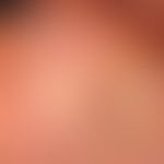 Skin graft, faulty. Fig. 10: Full-thickness skin graft from the abdominal skin used to cover the ...