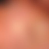 Skin graft, faulty. Fig. 10: Full-thickness skin graft from the abdominal skin used to cover the ...